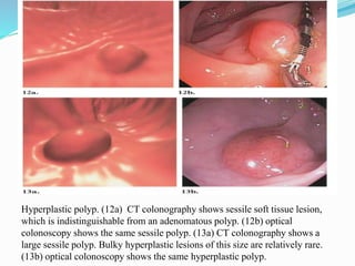 Hyperplastic polyp. (12a) CT colonography shows sessile soft tissue lesion,
which is indistinguishable from an adenomatous polyp. (12b) optical
colonoscopy shows the same sessile polyp. (13a) CT colonography shows a
large sessile polyp. Bulky hyperplastic lesions of this size are relatively rare.
(13b) optical colonoscopy shows the same hyperplastic polyp.
 