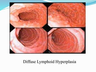 Diffuse Lymphoid Hyperplasia
 