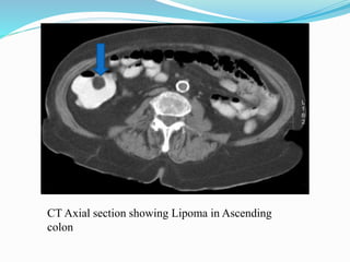 CT Axial section showing Lipoma in Ascending
colon
 