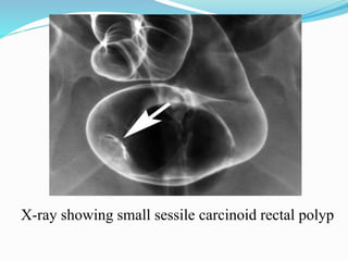 X-ray showing small sessile carcinoid rectal polyp
 