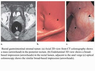 Rectal gastrointestinal stromal tumor. (a) Axial 2D view from CT colonography shows
a mass (arrowhead) in the posterior rectum. (b) Endoluminal 3D view shows a broad-
based impression (arrowheads) in the rectal lumen, adjacent to the anal verge (c) optical
colonoscopy shows the similar broad-based impression (arrowheads).
 