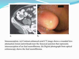 Intussusception. (a) Contrast-enhanced axial CT image shows a rounded low-
attenuation lesion (arrowhead) near the ileocecal junction that represents
intussusception of an ileal neuroﬁbroma. (b) Digital photograph from optical
colonoscopy shows the ileal neuroﬁbroma.
 