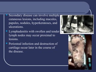 Secondary disease can involve multiple
cutaneous lesions, including macules,
papules, nodules, hyperkeratoses, and
ulcerations.
 Lymphadenitis with swollen and tender
lymph nodes may occur proximal to
lesions.
 Periosteal infection and destruction of
cartilage occur later in the course of
the disease.


 