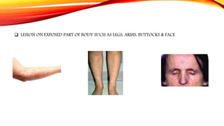  LESION ON EXPOSED PART OF BODY SUCH AS LEGS, ARMS, BUTTOCKS & FACE
 