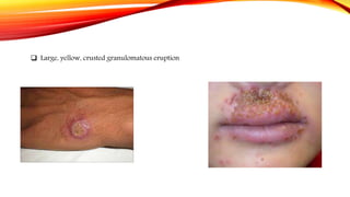  Large, yellow, crusted granulomatous eruption
 