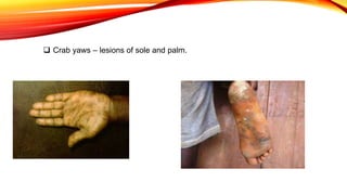  Crab yaws – lesions of sole and palm.
 