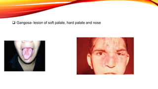  Gangosa- lesion of soft palate, hard palate and nose
 