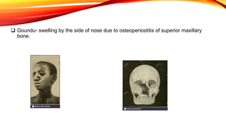 Goundu- swelling by the side of nose due to osteoperiostitis of superior maxillary
bone.
 