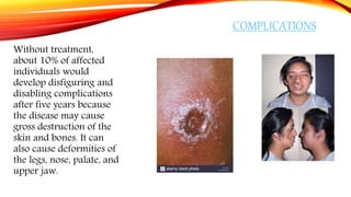 COMPLICATIONS
Without treatment,
about 10% of affected
individuals would
develop disfiguring and
disabling complications
after five years because
the disease may cause
gross destruction of the
skin and bones. It can
also cause deformities of
the legs, nose, palate, and
upper jaw.
 