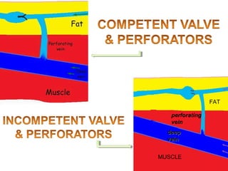 FAT
MUSCLE
perforating
vein
deepdeep
veinvein
 