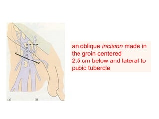 an oblique incision made in
the groin centered
2.5 cm below and lateral to
pubic tubercle
 