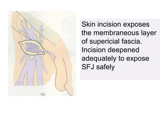 Skin incision exposes
the membraneous layer
of supericial fascia.
Incision deepened
adequately to expose
SFJ safely
 