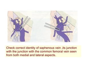 Check correct identity of saphenous vein ,its junction
with the junction with the common femoral vein seen
from both medial and lateral aspects.
 