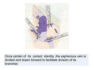 Once certain of its correct identity ,the saphenous vein is
divided and drawn forward to facilitate division of its
branches
 