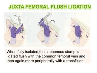 When fully isolated,the saphenous stump is
ligated flush with the common femoral vein and
then again,more peripherally,with a transfixion
 