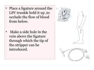 • Place a ligature around the
LSV trunk& hold it up ,to
occlude the flow of blood
from below.
• Make a side hole in the
vein above the ligature
through which the tip of
the stripper can be
introduced.
 