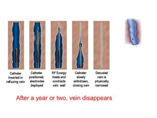 After a year or two, vein disappears
 