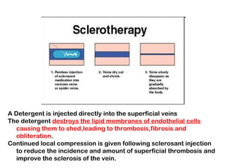 A Detergent is injected directly into the superficial veins
The detergent destroys the lipid membranes of endothelial cells
causing them to shed,leading to thrombosis,fibrosis and
obliteration.
Continued local compression is given following sclerosant injection
to reduce the incidence and amount of superficial thrombosis and
improve the sclerosis of the vein.
 
