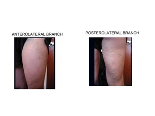 ANTEROLATERAL BRANCH POSTEROLATERAL BRANCH
 