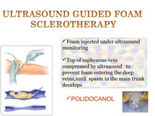 Foam injected under ultrasound
monitoring
Top of saphenous vein
compressed by ultrasound to
prevent foam entering the deep
veins,until spasm in the main trunk
develops
POLIDOCANOL
 