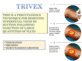 THIS IS A PERCUTANEOUS
TECHNIQUE FOR REMOVING
SUPERFICIAL VEINS BY
SUCTION FOLLOWING
INJECTION OF LARGE
QUANTITIES OF FLUID
THIS IS A PERCUTANEOUS
TECHNIQUE FOR REMOVING
SUPERFICIAL VEINS BY
SUCTION FOLLOWING
INJECTION OF LARGE
QUANTITIES OF FLUID
IINDURATION
BRUISING
SUBCUTANEOUS GROOVES
 