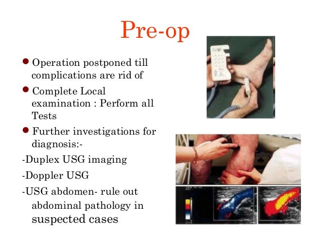 Varicose Vein Surgery