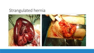 Strangulated hernia
 