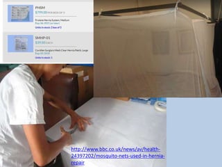 http://www.bbc.co.uk/news/av/health-
24397202/mosquito-nets-used-in-hernia-
repair
 