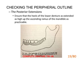 CHECKING THE PERIPHERAL OUTLINE
– The Posterior Extensions
• Ensure that the heels of the lower denture as extended
as high up the ascending ramus of the mandible as
practicable.
COMPLETE DENTURE TRY-IN 19
19/80
 
