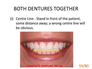 BOTH DENTURES TOGETHER
(i) Centre Line - Stand in front of the patient,
some distance away; a wrong centre line will
be obvious.
COMPLETE DENTURE TRY-IN 59
59/80
 