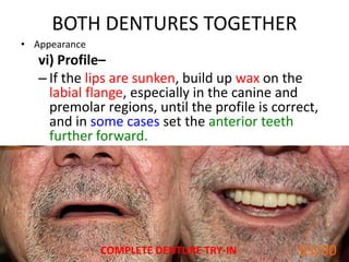 BOTH DENTURES TOGETHER
• Appearance
vi) Profile–
– If the lips are sunken, build up wax on the
labial flange, especially in the canine and
premolar regions, until the profile is correct,
and in some cases set the anterior teeth
further forward.
COMPLETE DENTURE TRY-IN 63
63/80
 
