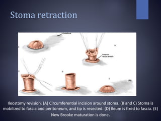Stoma retraction
Ileostomy revision. (A) Circumferential incision around stoma. (B and C) Stoma is
mobilized to fascia and peritoneum, and tip is resected. (D) Ileum is fixed to fascia. (E)
New Brooke maturation is done.
 