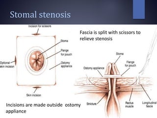 Stomal stenosis
Incisions are made outside ostomy
appliance
Fascia is split with scissors to
relieve stenosis
 