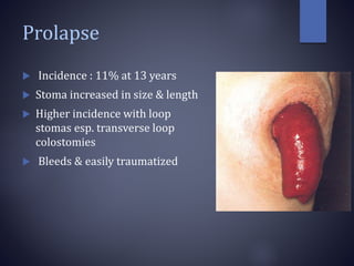 Prolapse
 Incidence : 11% at 13 years
 Stoma increased in size & length
 Higher incidence with loop
stomas esp. transverse loop
colostomies
 Bleeds & easily traumatized
 