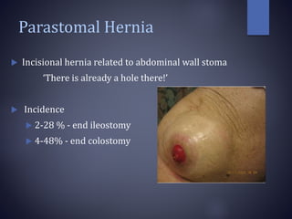 Parastomal Hernia
 Incisional hernia related to abdominal wall stoma
‘There is already a hole there!’
 Incidence
 2-28 % - end ileostomy
 4-48% - end colostomy
 