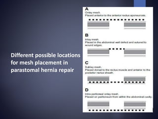 Different possible locations
for mesh placement in
parastomal hernia repair
 