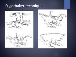 Sugarbaker technique
 
