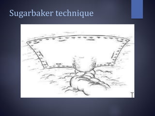 Sugarbaker technique
 