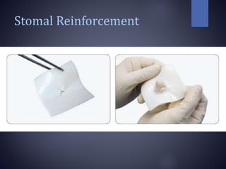Stomal Reinforcement
 