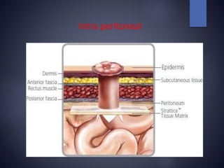 Intra peritoneal
 