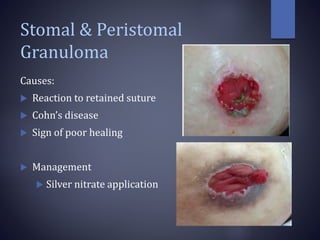 Stomal & Peristomal
Granuloma
Causes:
 Reaction to retained suture
 Cohn’s disease
 Sign of poor healing
 Management
 Silver nitrate application
 