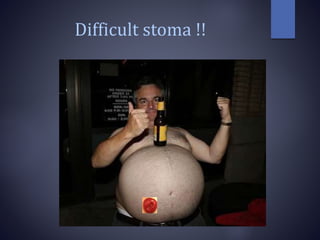 Difficult stoma !!
 