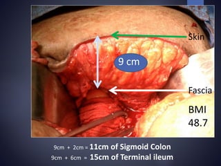 Skin
Fascia
9 cm
9cm + 2cm = 11cm of Sigmoid Colon
9cm + 6cm = 15cm of Terminal ileum
BMI
48.7
 