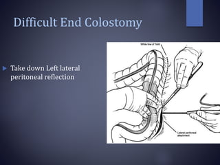Difficult End Colostomy
 Take down Left lateral
peritoneal reflection
 