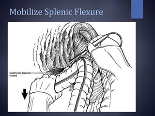 Mobilize Splenic Flexure
 