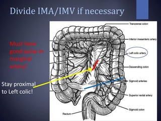 Divide IMA/IMV if necessary
Must have
good pulse in
marginal
artery!
Stay proximal
to Left colic!
 