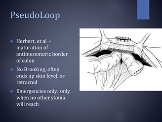 PseudoLoop
 Herbert, et al -
maturation of
antimesenteric border
of colon
 No Brooking, often
ends up skin level, or
retracted
 Emergencies only, only
when no other stoma
will reach
 