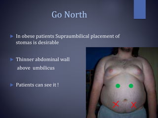 Go North
 In obese patients Supraumbilical placement of
stomas is desirable
 Thinner abdominal wall
above umbilicus
 Patients can see it !
 