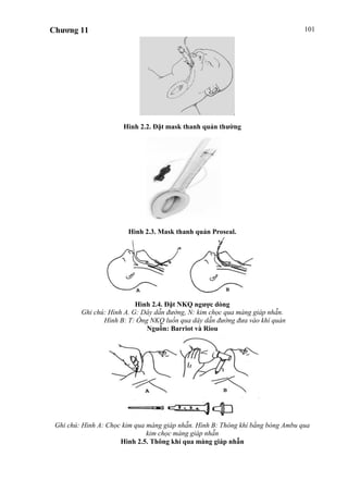 Chương 11 101
Hình 2.2. Đặt mask thanh quản thường
Hình 2.3. Mask thanh quản Proseal.
Hình 2.4. Đặt NKQ ngược dòng
Ghi chú: Hình A. G: Dây dẫn đường, N: kim chọc qua màng giáp nhẫn.
Hình B: T: Ống NKQ luồn qua dây dẫn đường đưa vào khí quản
Nguồn: Barriot và Riou
Hình 2.5. Kỹ thuật thông khí qua màng giáp nhẫn
Ghi chú: Hình A: Chọc kim qua màng giáp nhẫn. Hình B: Thông khí bằng bóng Ambu qua
kim chọc màng giáp nhẫn
Hình 2.5. Thông khí qua màng giáp nhẫn
 