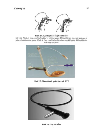 Chương 11 102
Hình 2.6. Kỹ thuật đặt ống Combitube
Ghi chú: Hình A: Óng combitube đặt ở vị trí thực quản, không khí vào khí quản qua các lỗ
nằm trên thành thực quản. Hình B: Ống combitube đặt nằm trong khí quản, không khí vào
trực tiếp khí quản
Hình 2.7. Mask thanh quản fastrach ETT
Hình 2.8. Nội soi mềm
 